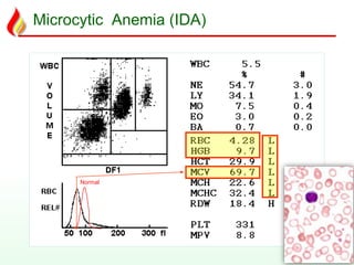 Microcytic Anemia (IDA)
7
Normal
 