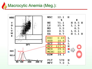 Macrocytic Anemia (Meg.):
9
Normal
H
N
 