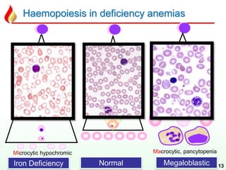 Haemopoiesis in deficiency anemias
13
Macrocytic, pancytopeniaMicrocytic hypochromic
Iron Deficiency Normal Megaloblastic
 