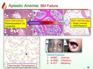 Aplastic Anemia: BM Failure
15
Dysplasia Normal BM Aplasia
Clinical Features:
1. RBC - Anemia,
2.  WBC - Infections
3.  PLT - Bleeding
Stem cell damage
• Drugs, Immune
• Viral Infections.
Stem Cell Cancer:
Myelodysplastic Sy.
Leukemia
Normocytic Pancytopenia
 