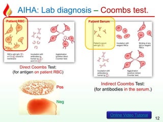 AIHA: Lab diagnosis – Coombs test.
12
Direct Coombs Test:
(for antigen on patient RBC)
Indirect Coombs Test:
(for antibodies in the serum.)
Pos
Neg
Online Video Tutorial
Patient RBC Patient Serum
 