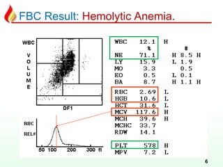 FBC Result: Hemolytic Anemia.
6
 
