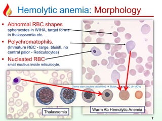 Hemolytic anemia: Morphology
7
 Abnormal RBC shapes
spherocytes in WIHA, target forms
in thalasssemia etc.
 Polychromatophils.
(Immature RBC - large, bluish, no
central palor - Reticulocytes)
 Nucleated RBC
small nucleus inside reticulocyte.
Thalassemia
Warm Ab Hemolytic Anemia
Giems stain (routine blood film)  Bluish, Large RBC ( MCV)
 