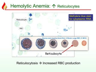 Hemolytic Anemia:  Reticulocytes
Reticulocyte
RBC
Reticulocytosis  Increased RBC production
Methylene blue stain
for cytoplasmic RNA
Giemsa stain (routine blood film)  Bluish, Large RBC ( MCV)
 