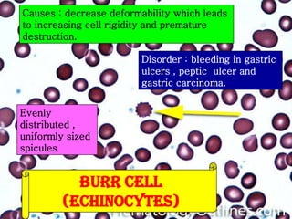 Causes : decrease deformability which leads
to increasing cell rigidity and premature
destruction.
Disorder : bleeding in gastric
ulcers , peptic ulcer and
gastric carcinoma.
Evenly
distributed ,
uniformly sized
spicules

BURR CELL
(ECHINOCYTES)

 