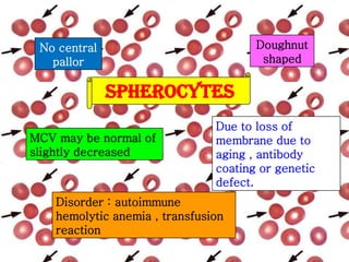 Doughnut
shaped

No central
pallor

SPHEROCYTES
MCV may be normal of
slightly decreased

Due to loss of
membrane due to
aging , antibody
coating or genetic
defect.

Disorder : autoimmune
hemolytic anemia , transfusion
reaction

 