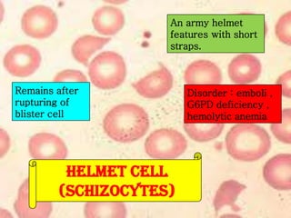 An army helmet
features with short
straps.

Remains after
rupturing of
blister cell

HELMET CELL
(SCHIZOCYTES)

Disorder : emboli ,
G6PD deficiency ,
hemolytic anemia

 