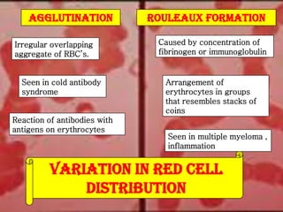 AGGLUTINATION
Irregular overlapping
aggregate of RBC’s.

Seen in cold antibody
syndrome

Reaction of antibodies with
antigens on erythrocytes

ROULEAUX FORMATION
Caused by concentration of
fibrinogen or immunoglobulin

Arrangement of
erythrocytes in groups
that resembles stacks of
coins
Seen in multiple myeloma ,
inflammation

VARIATION IN RED CELL
DISTRIBUTION

 