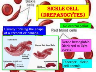 Sickle cell
(drepanocytes)
Usually forming the shape
of a cresent or banana.

No central pallor

Dense hemoglobin
(dark red to light
purple)

Disorder : sickle
cell anemia

 