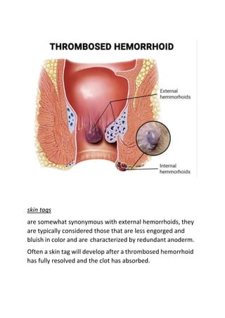 skin tags
are somewhat synonymous with external hemorrhoids, they
are typically considered those that are less engorged and
bluish in color and are characterized by redundant anoderm.
Often a skin tag will develop after a thrombosed hemorrhoid
has fully resolved and the clot has absorbed.
 