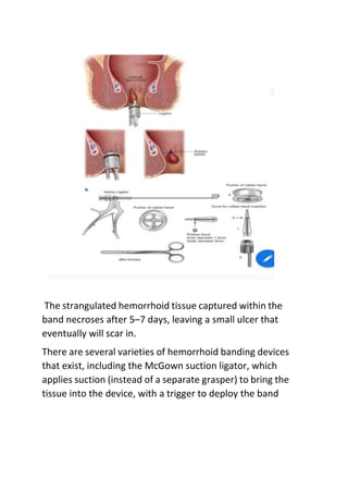 The strangulated hemorrhoid tissue captured within the
band necroses after 5–7 days, leaving a small ulcer that
eventually will scar in.
There are several varieties of hemorrhoid banding devices
that exist, including the McGown suction ligator, which
applies suction (instead of a separate grasper) to bring the
tissue into the device, with a trigger to deploy the band
 