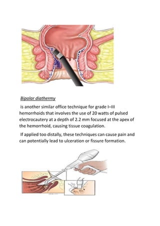 Bipolar diathermy
is another similar office technique for grade I–III
hemorrhoids that involves the use of 20 watts of pulsed
electrocautery at a depth of 2.2 mm focused at the apex of
the hemorrhoid, causing tissue coagulation.
If applied too distally, these techniques can cause pain and
can potentially lead to ulceration or fissure formation.
 