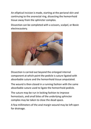 An elliptical incision is made, starting at the perianal skin and
continuing to the anorectal ring, dissecting the hemorrhoid
tissue away from the sphincter complex.
Dissection can be completed with a scissors, scalpel, or Bovie
electrocautery.
Dissection is carried out beyond the enlarged internal
component at which point the pedicle is suture ligated with
absorbable suture and the hemorrhoid tissue amputated.
The wound is then closed in a running fashion with the same
absorbable suture used to ligate the hemorrhoid pedicle.
The suture may be run in locking fashion to improve
hemostasis, and small bites of the underlying sphincter
complex may be taken to close the dead space.
A few millimeters of the anal margin wound may be left open
for drainage.
 