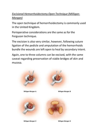 Excisional Hemorrhoidectomy Open Technique (Milligan-
Morgan)
The open technique of hemorrhoidectomy is commonly used
in the United Kingdom.
Perioperative considerations are the same as for the
Ferguson technique.
The excision is also very similar, however, following suture
ligation of the pedicle and amputation of the hemorrhoids
bundle the wounds are left open to heal by secondary intent.
Again, one to three columns can be excised, with the same
caveat regarding preservation of viable bridges of skin and
mucosa.
 