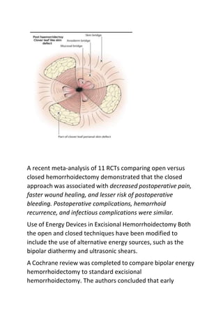 A recent meta-analysis of 11 RCTs comparing open versus
closed hemorrhoidectomy demonstrated that the closed
approach was associated with decreased postoperative pain,
faster wound healing, and lesser risk of postoperative
bleeding. Postoperative complications, hemorrhoid
recurrence, and infectious complications were similar.
Use of Energy Devices in Excisional Hemorrhoidectomy Both
the open and closed techniques have been modified to
include the use of alternative energy sources, such as the
bipolar diathermy and ultrasonic shears.
A Cochrane review was completed to compare bipolar energy
hemorrhoidectomy to standard excisional
hemorrhoidectomy. The authors concluded that early
 