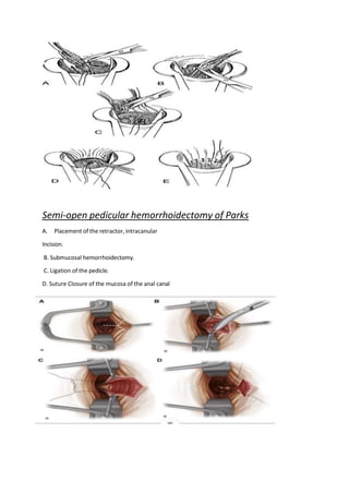 Semi-open pedicular hemorrhoidectomy of Parks
A. Placement of the retractor, intracanular
Incision.
B. Submucosal hemorrhoidectomy.
C. Ligation of the pedicle.
D. Suture Closure of the mucosa of the anal canal
 