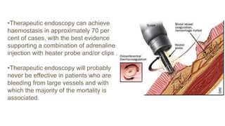•Therapeutic endoscopy can achieve
haemostasis in approximately 70 per
cent of cases, with the best evidence
supporting a combination of adrenaline
injection with heater probe and/or clips .
•Therapeutic endoscopy will probably
never be effective in patients who are
bleeding from large vessels and with
which the majority of the mortality is
associated.
 