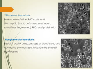 Eumorphic Rbc Haematuria | PPT