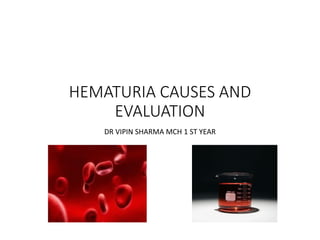 HEMATURIA CAUSES AND
EVALUATION
DR VIPIN SHARMA MCH 1 ST YEAR
 