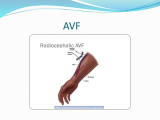 AVF 
 