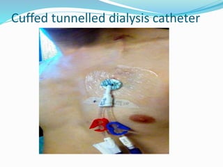 Cuffed tunnelled dialysis catheter 
 