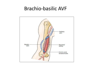 Haemodialysis access surgeries | PPTX