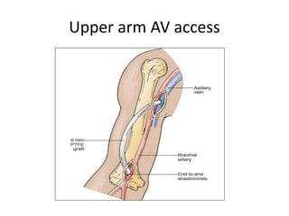 Haemodialysis access surgeries | PPTX