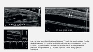Haemodialysis fistula doppler | PPTX
