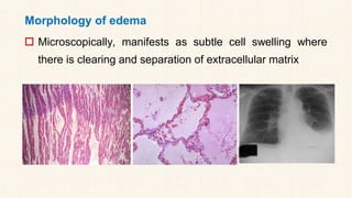 Morphology of edema
 Microscopically, manifests as subtle cell swelling where
there is clearing and separation of extracellular matrix
 