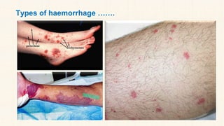 Types of haemorrhage …….
 