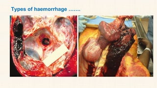 Types of haemorrhage …….
 