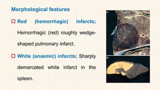 Morphological features
 Red (hemorrhagic) infarcts;
Hemorrhagic (red) roughly wedge-
shaped pulmonary infarct.
 White (anaemic) infarcts; Sharply
demarcated white infarct in the
spleen.
 