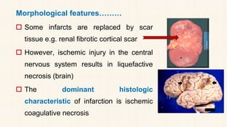 Morphological features………
 Some infarcts are replaced by scar
tissue e.g. renal fibrotic cortical scar
 However, ischemic injury in the central
nervous system results in liquefactive
necrosis (brain)
 The dominant histologic
characteristic of infarction is ischemic
coagulative necrosis
 