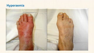 Hyperaemia
 