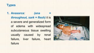 Types
1. Anasarca: (ana =
throughout, sark = flesh) it is
a severe and generalized form
of edema with widespread
subcutaneous tissue swelling
usually caused by renal
failure, liver failure, heart
failure
 