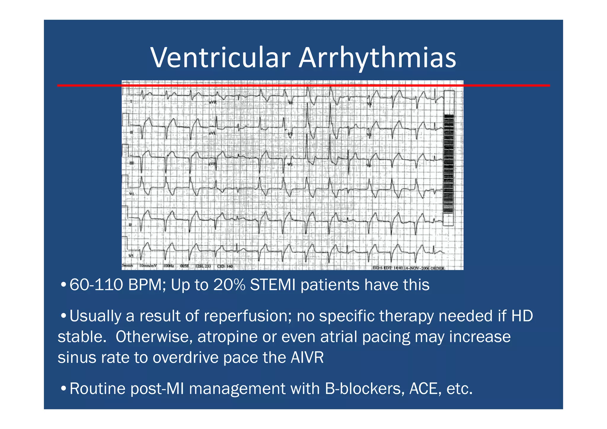 Ventricular Arrhythmias
•60-110 BPM; Up to 20% STEMI patients have this
•Usually a result of reperfusion; no specific therapy needed if HD
stable. Otherwise, atropine or even atrial pacing may increase
sinus rate to overdrive pace the AIVR
•Routine post-MI management with B-blockers, ACE, etc.
 