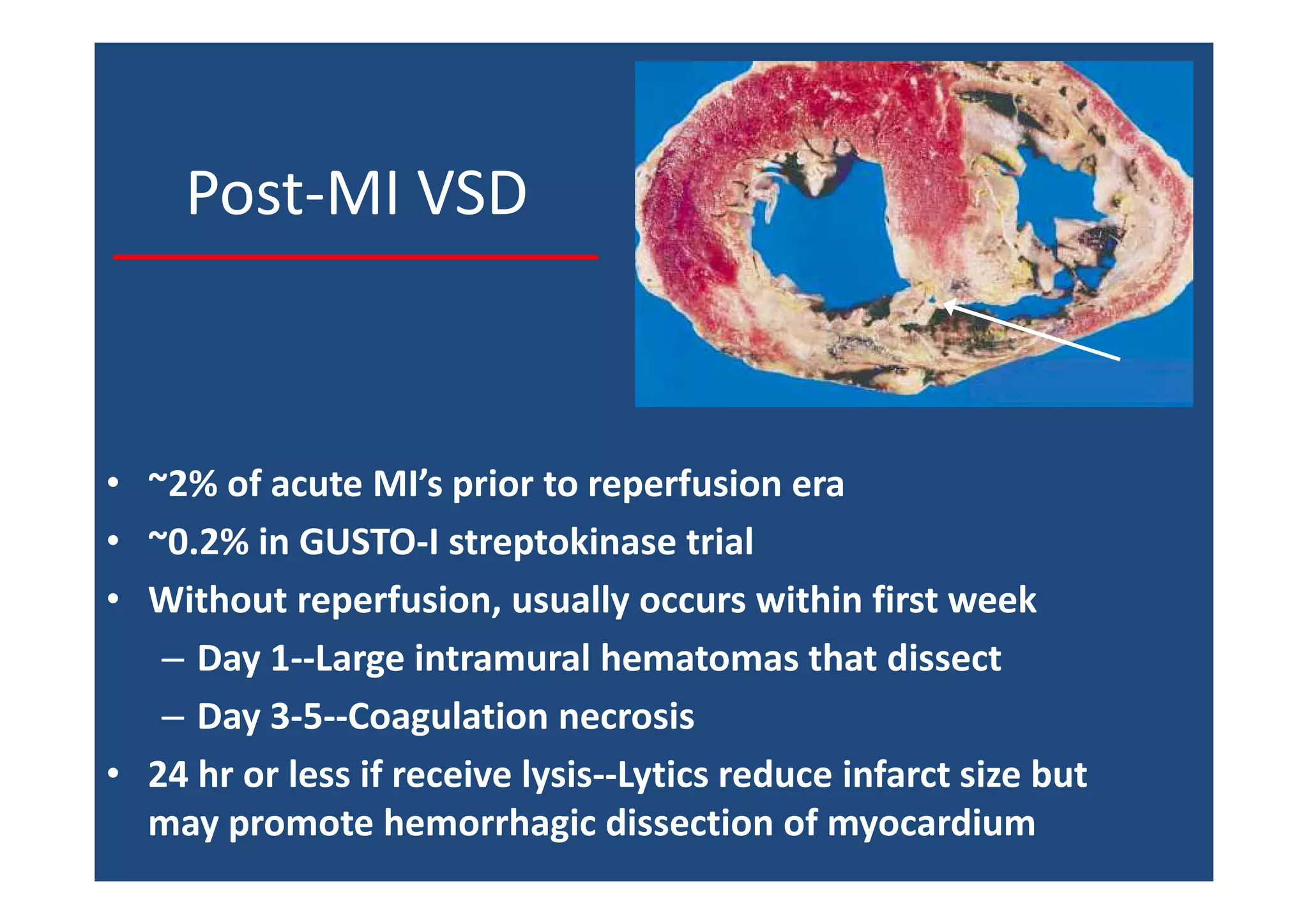 Post-MI VSD
• ~2% of acute MI’s prior to reperfusion era
• ~0.2% in GUSTO-I streptokinase trial
• Without reperfusion, usually occurs within first week
– Day 1--Large intramural hematomas that dissect
– Day 3-5--Coagulation necrosis
• 24 hr or less if receive lysis--Lytics reduce infarct size but
may promote hemorrhagic dissection of myocardium
 