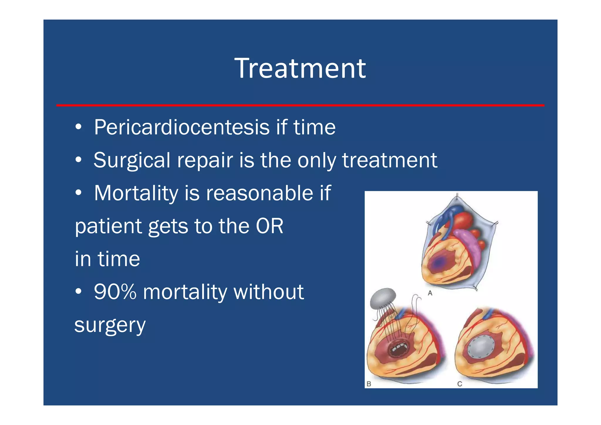 Treatment
• Pericardiocentesis if time
• Surgical repair is the only treatment
• Mortality is reasonable if
patient gets to the OR
in time
• 90% mortality without
surgery
 