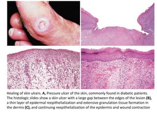 Healing of skin ulcers. A, Pressure ulcer of the skin, commonly found in diabetic patients.
The histologic slides show a skin ulcer with a large gap between the edges of the lesion (B),
a thin layer of epidermal reepithelialization and extensive granulation tissue formation in
the dermis (C), and continuing reepithelialization of the epidermis and wound contraction
 