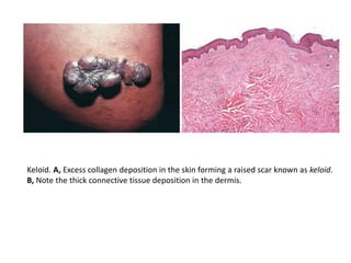 Keloid. A, Excess collagen deposition in the skin forming a raised scar known as keloid.
B, Note the thick connective tissue deposition in the dermis.
 