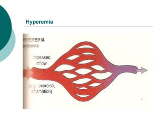 Hyperemia
 