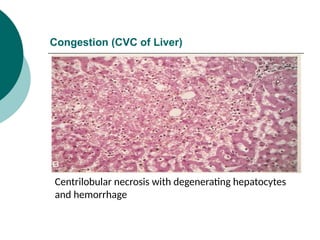 Congestion (CVC of Liver)
Centrilobular necrosis with degenerating hepatocytes
and hemorrhage
 