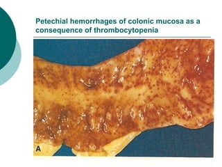 Petechial hemorrhages of colonic mucosa as a
consequence of thrombocytopenia
 