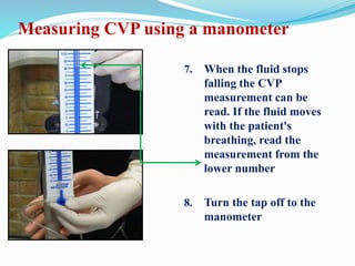 7. When the fluid stops
falling the CVP
measurement can be
read. If the fluid moves
with the patient's
breathing, read the
measurement from the
lower number
8. Turn the tap off to the
manometer
Measuring CVP using a manometer
 