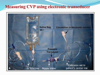 Measuring CVP using electronic transeducer
 