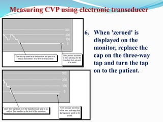 6. When 'zeroed' is
displayed on the
monitor, replace the
cap on the three-way
tap and turn the tap
on to the patient.
Measuring CVP using electronic transeducer
 