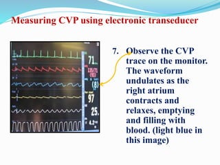 7. Observe the CVP
trace on the monitor.
The waveform
undulates as the
right atrium
contracts and
relaxes, emptying
and filling with
blood. (light blue in
this image)
Measuring CVP using electronic transeducer
 