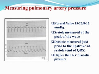 Measuring pulmonary artery pressure
Normal Value 15-25/8-15
mmHg.
Systole measured at the
peak of the wave
Diastole measured just
prior to the upstroke of
systole (end of QRS)
Higher than RV diastolic
pressure
 