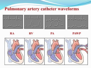 Pulmonary artery catheter waveforms
RA RV PA PAWP
 