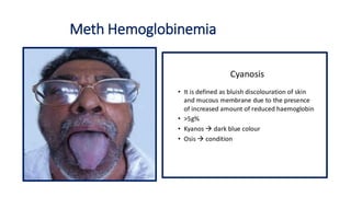Meth Hemoglobinemia
 